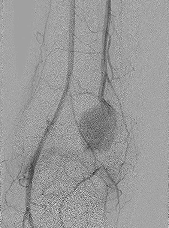 Pseudoaneurysm Angiography